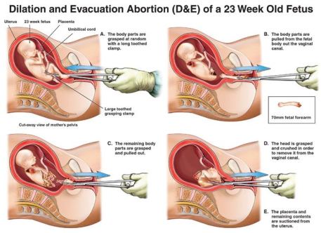 Abortion Procedures