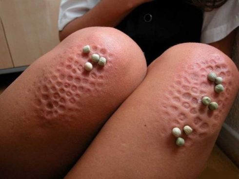 Kneeling On Frozen Peas