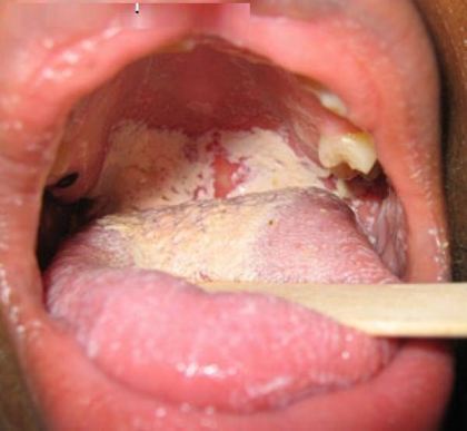 Mouth Yeast Infection Symptoms