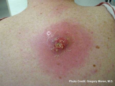 Mrsa Staph Infection