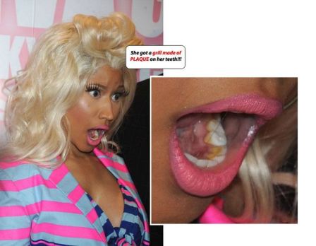Nicki Minaj Teeth