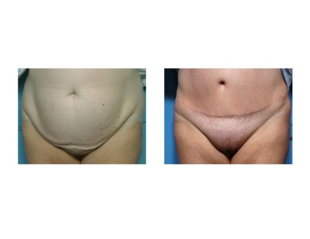 Nude Girl Surgery Scar