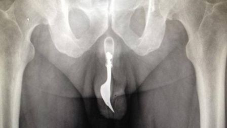 Penis Stuck Inside Body