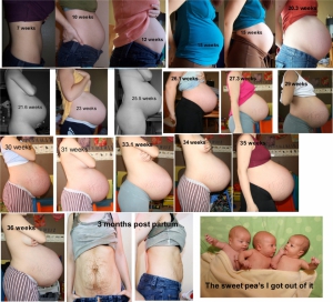 Pregnant With Triplets Belly