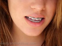 Shemale With Braces Porn