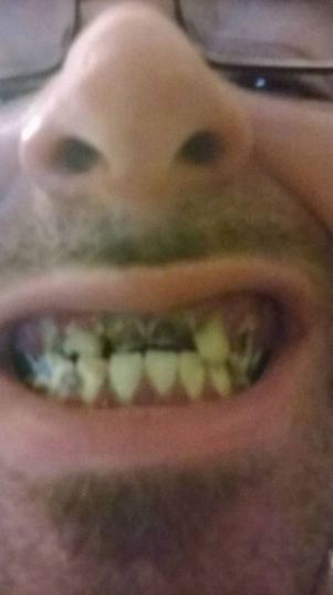 Teeth Hurt