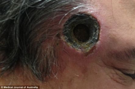 Black Hole In Skin