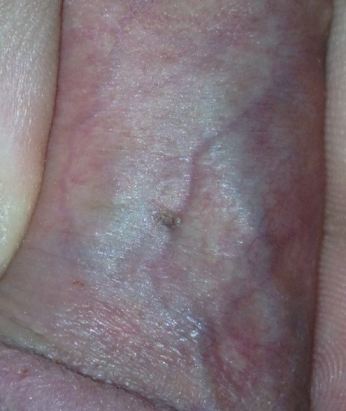 Black Spots On Penis Shaft