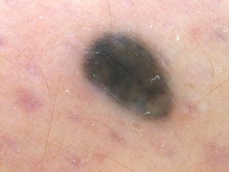 Black Spots On Penis