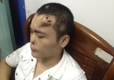Chinese Man With Nose On Forehead