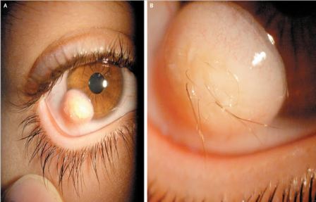 Hair Growing In Eye