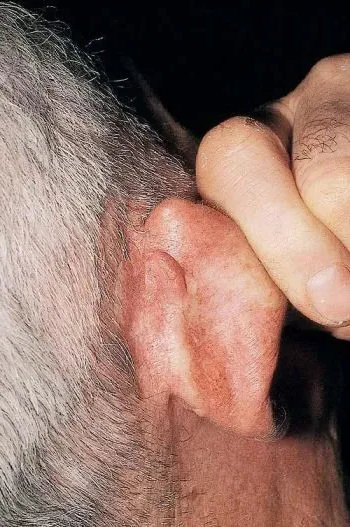 ear acanthoma fissuratum